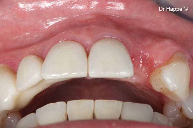 4. A horizontal bone defect is evident