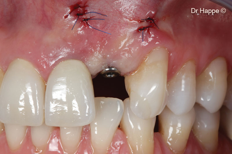 11. Second stage surgery and removal of the 2 pins 3 months after the surgery was perfomed minimally invasively, without raising a flap