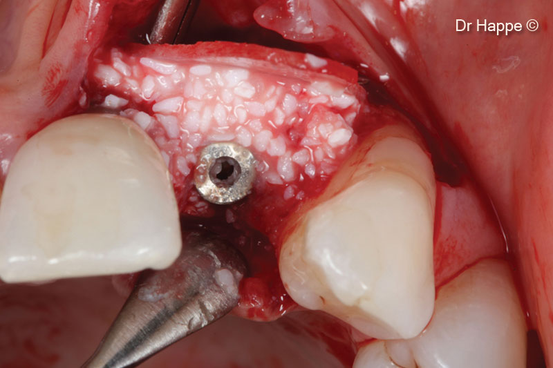6. Lateral bone augmentation with mp3<sup>®</sup> and bone Lamina