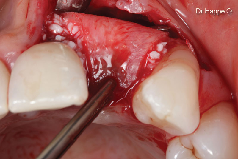 7. The Lamina has been adapted to the defect and secured with two titanium pins buccall
