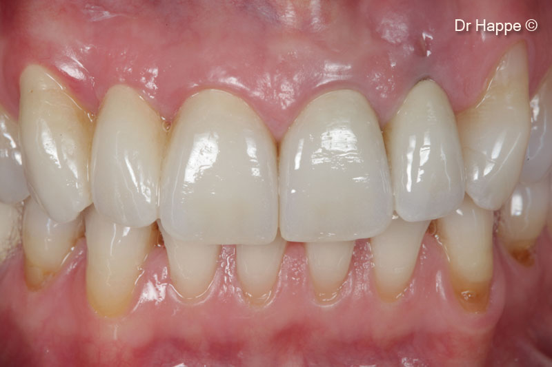 1. Initial situation with fistula buccal of the left lateral incisor due to long axis fracture