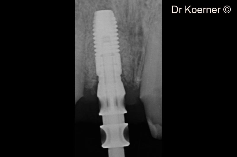 13. X-ray after 4 months post-op at impression taking