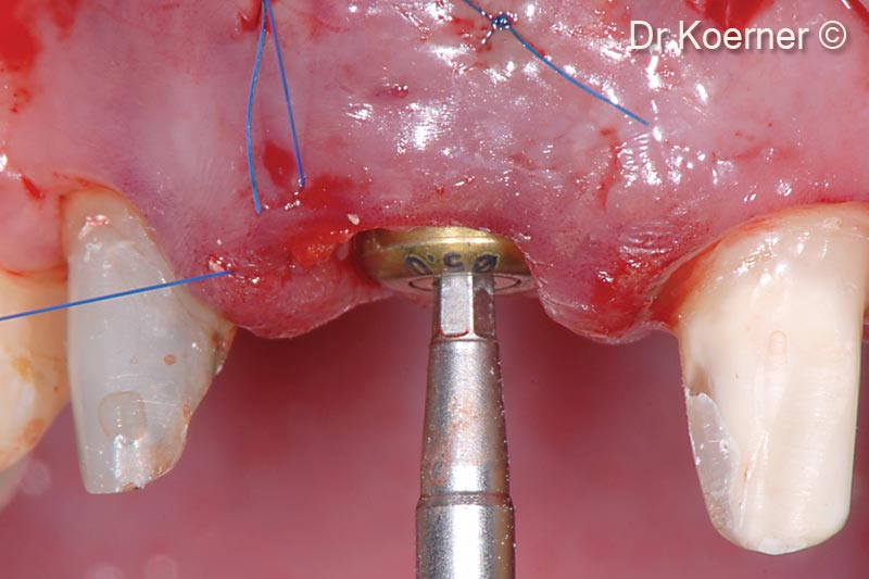 12. Replacing the cover screw by an adequate healing abutment to support the new bony wall and the connective tissue