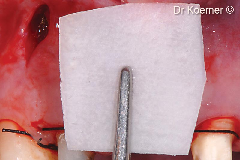 8. Bone Lamina before insertion with indirect tunnel opening to help unfolding the inserted Lamina on top of the defect borders