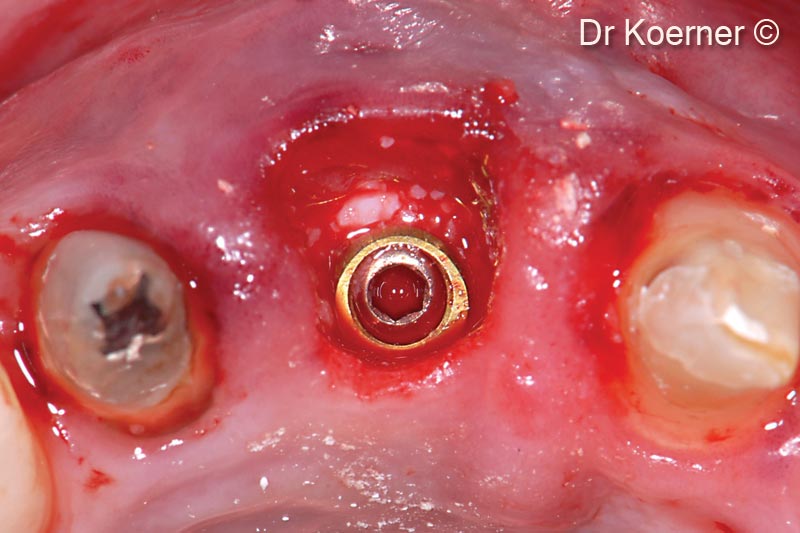 10. ASTRA Profile with cover screw to allow bone grafting of mp3<sup>®</sup> between implant and replaced buccal wall (bone Lamina)