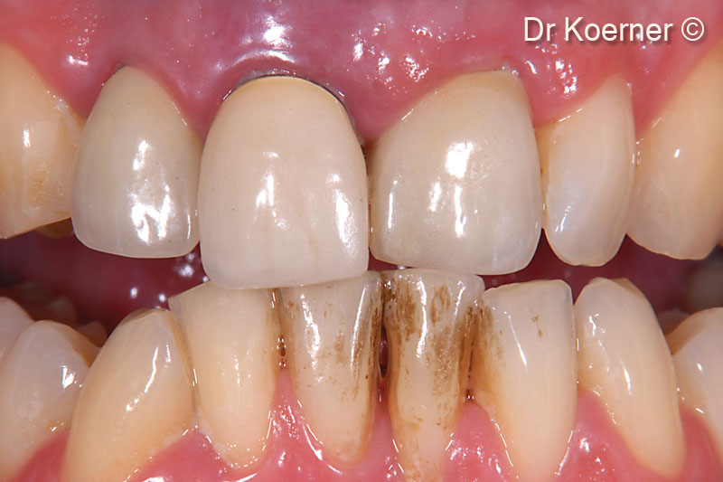 1. Initial situation: extended combined perio-endo lesion 11, buccal wall missing