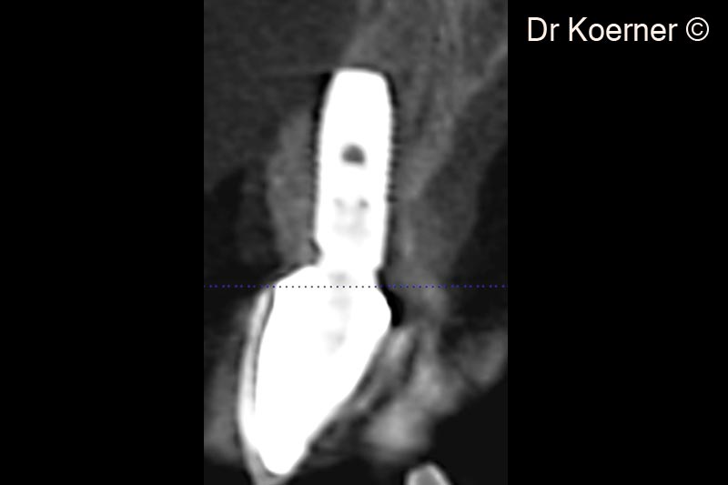 14. CBTC 6 months after prostho-delivering to demonstrate the new bony buccal wall