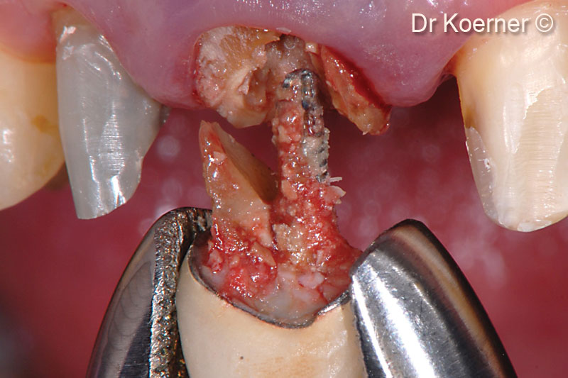 4. Extraction of the multi-fractured tooth 11