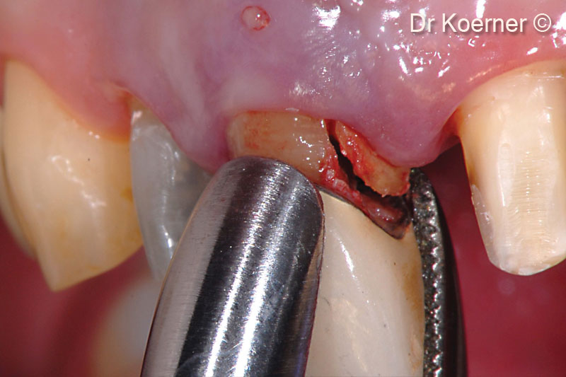 3. Extraction of the multi-fractured tooth 11