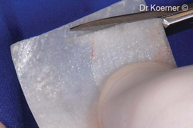 9. Cutting the soft bone Lamina according to a paper template matching the deficient bony wall