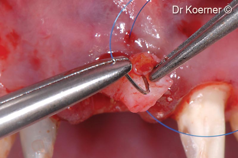 11. Additional grafting of a thin autogenous connective tissue 