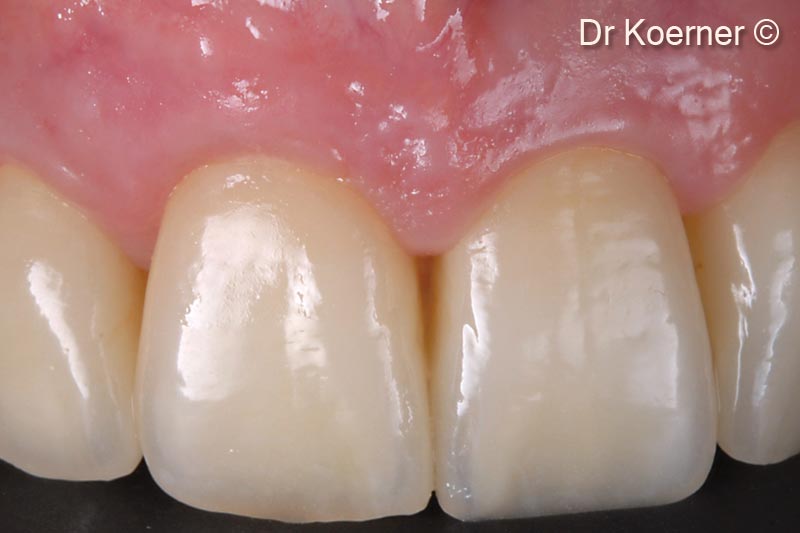 16. Final situation 6 months after ceramic restoration of the upper front #13-#23 (full ceramic: #12, implant #11, #21 ceramic veneers: #13, #22, #23)