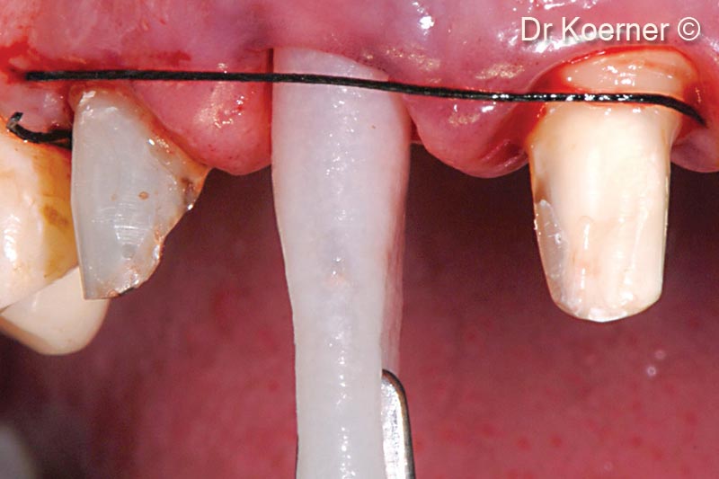 7. Inserting a defect related, folded soft bone Lamina