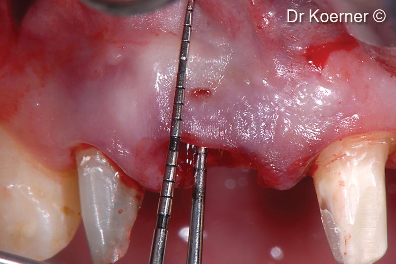 5. Periodontal probes to demonstrate the extension of the missing buccal bony wall