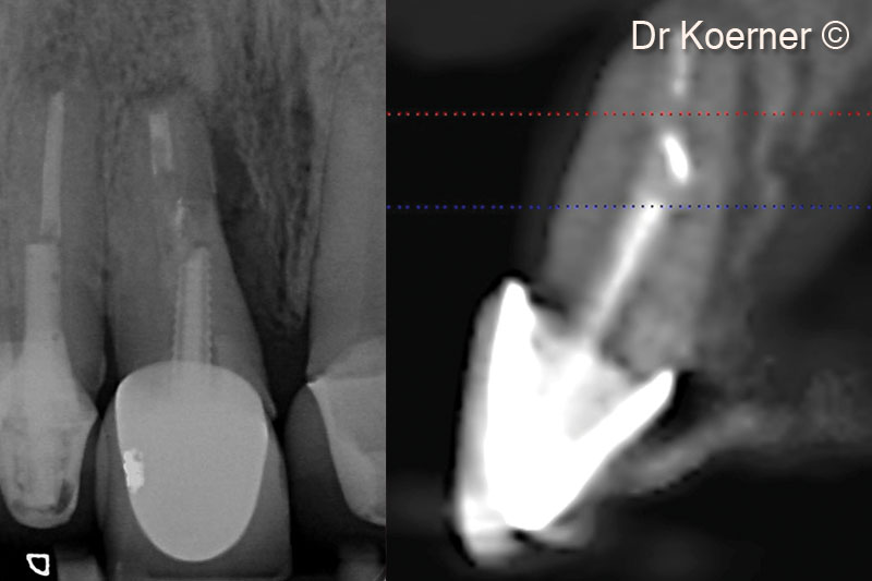 2. Initial x-ray examination 11: missing buccal wall plus vertical defect to the apex