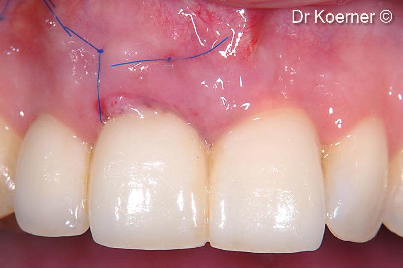 15. 1 week post-op with provisional in place to condition the soft tissue profile