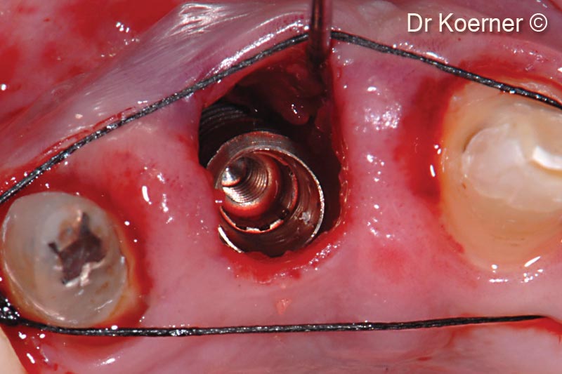 6. Placement of 4,2mm ASTRA Profile next to the palatal wall, see the buccal deficiency