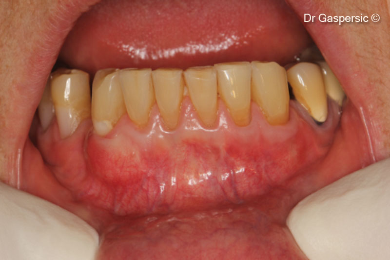 15. Complete area two years after surgery