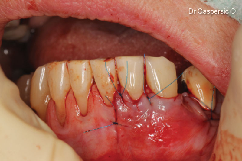 12. Wound closure
