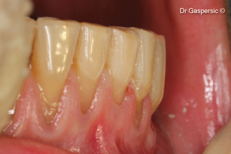 5. Enamel defects restored with composite material