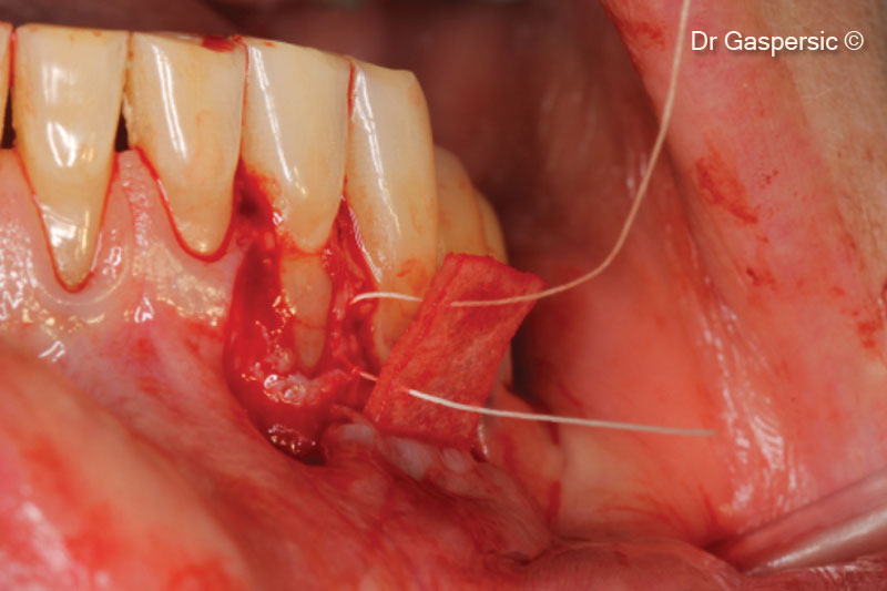9. OsteoBiol<sup>®</sup> Derma suturing with mattress sutures to periosteum