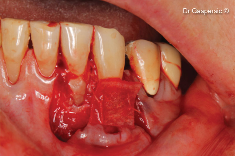 Derma membrane as a replacement of...