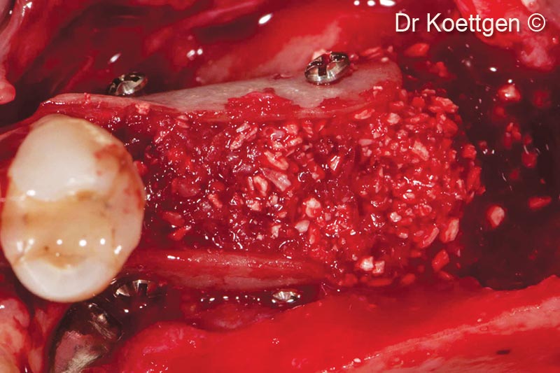 7. Filled up with autogenous bone mixed with OsteoBiol<sup>®</sup> Apatos