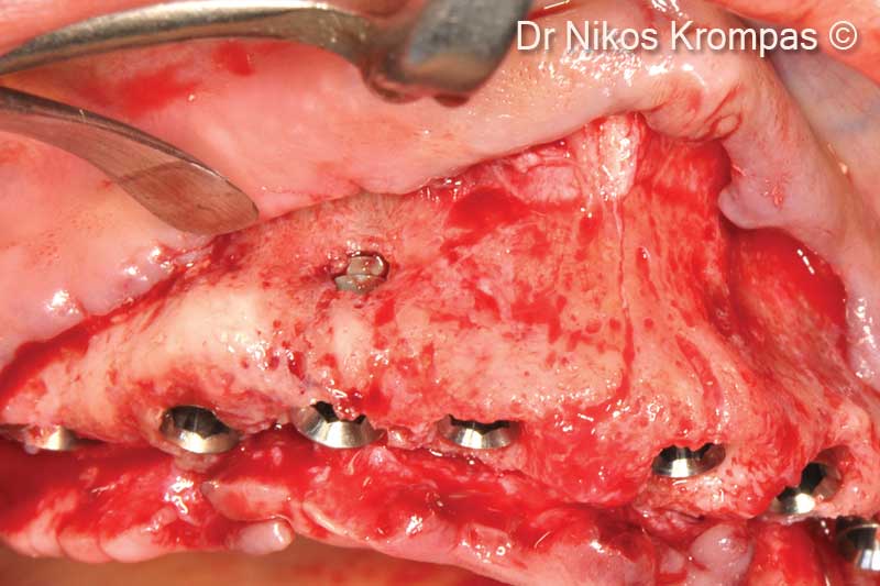 3. Occlusal view of implants in place