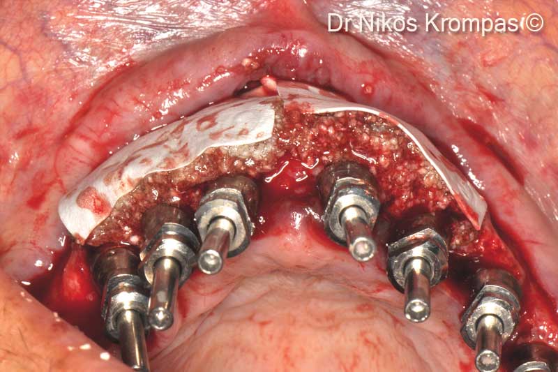 7. Occlusal view of the graft and membranes