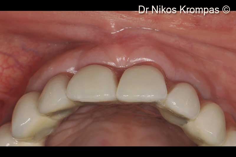 13. Semi occlusal view of the final bridge. Note the excellent soft tissue contours