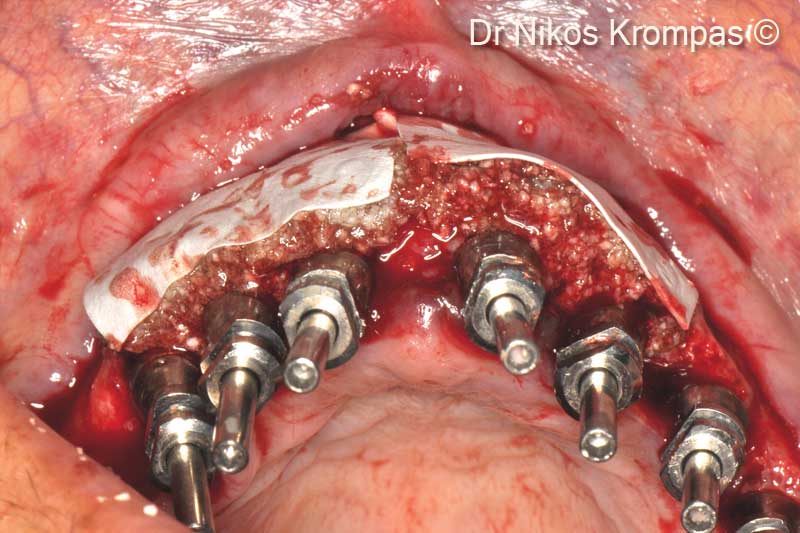 Buccal contour augmentation graft of...