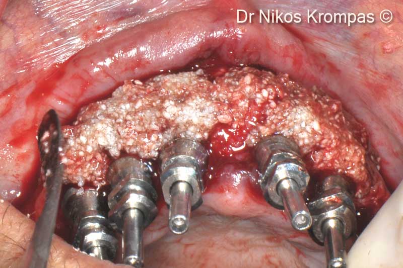 4. Placement of sticky bone graft composed of Gen-Os<sup>®</sup> mixed with TSV Gel