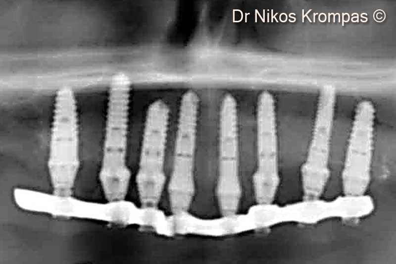 9. Radiograpic view of implants and provisional immediate load bridge