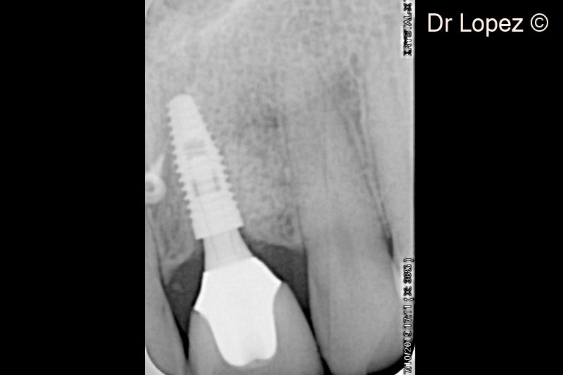 21. X-ray control at 3 years