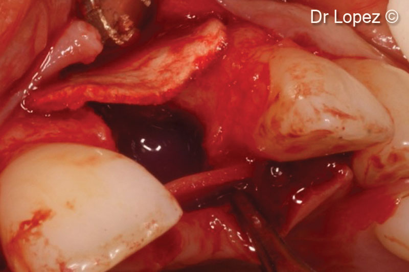 7. View of the defect grafted with Lamina