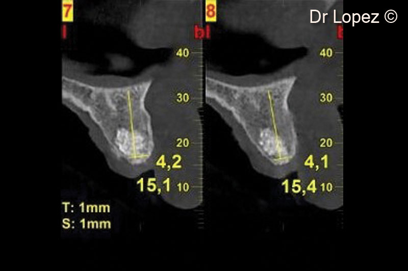 14. Post-operative cone beam scan at implant placement (8 months after surgery)