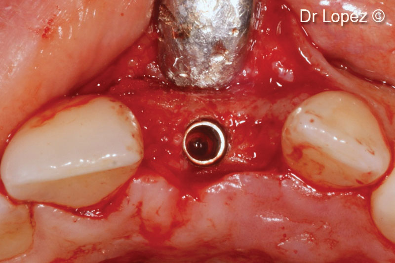 17. Positioning of a 3.5x10mm implant