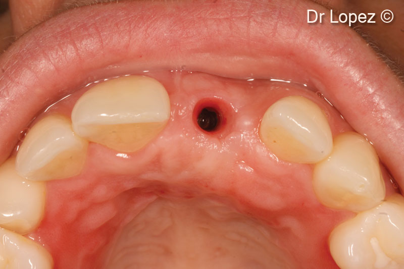18. Tissue conditioning around implants