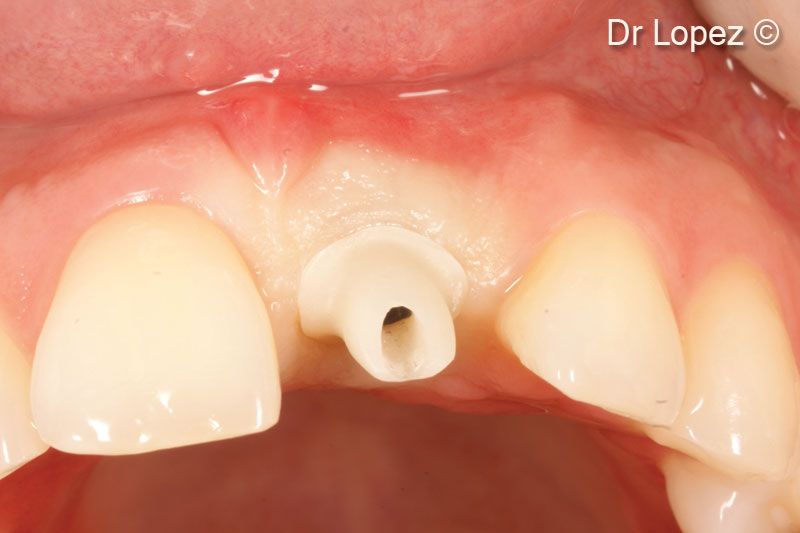 19. Ti-base abutment