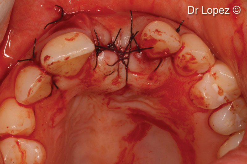 12. Flap closure