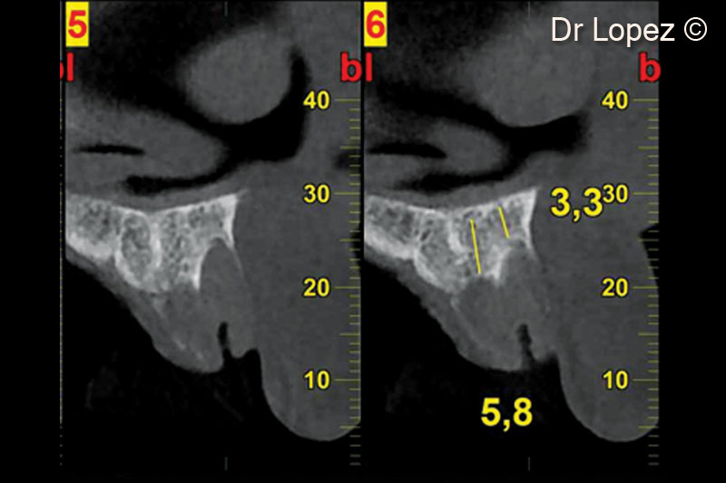 2. Pre-operative cone beam scan
