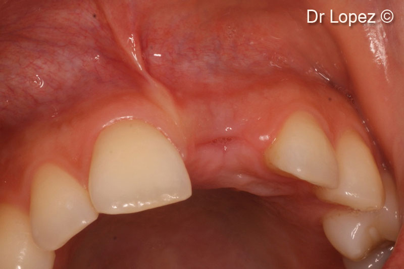 3.  Post-traumatic bone defect