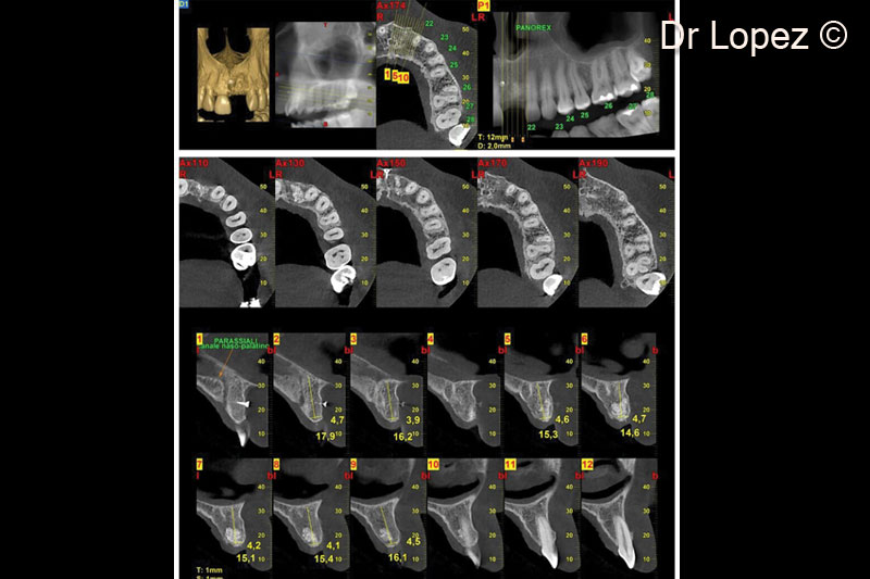 13. Post-operative cone beam scan at implant placement (8 months after surgery)