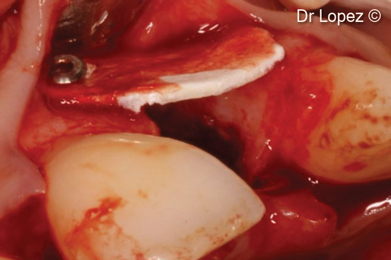 6. Fixation of the Lamina on the vestibular bone with titanium pins