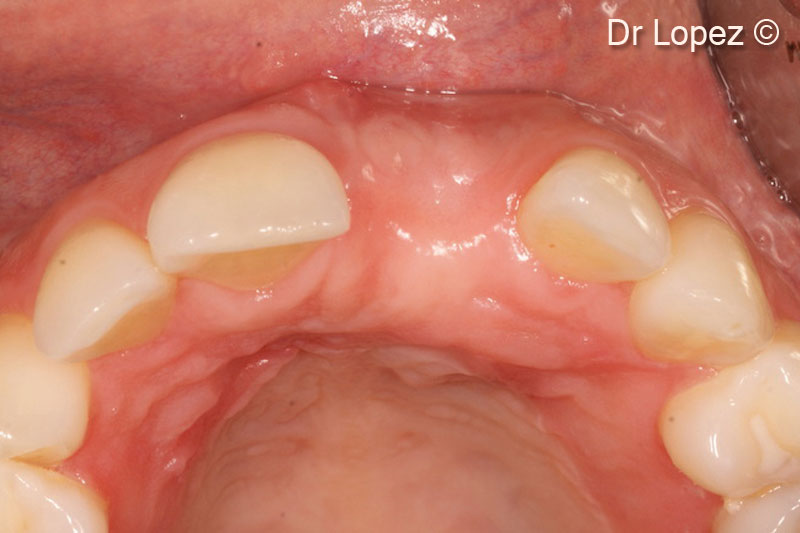 15. Pre-operative view of the augmented area