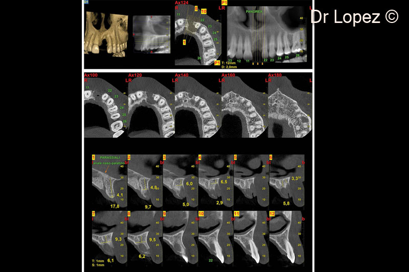 1. Pre-operative cone beam scan