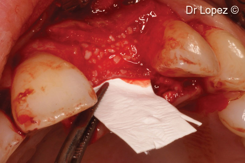 10. Covering of the grafted area with Evolution membrane