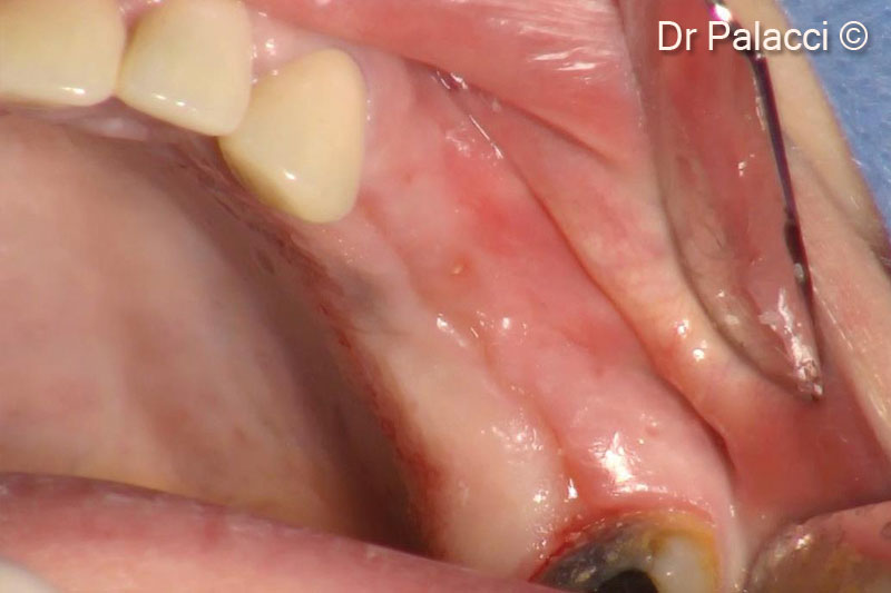 7. Re-entry 4 months later. Note the significant labial ridge augmentation as well as the soft tissue quality