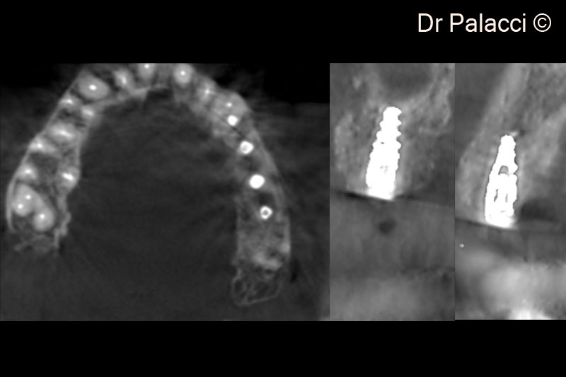 10. X-ray illustrating the labial ridge augmentation