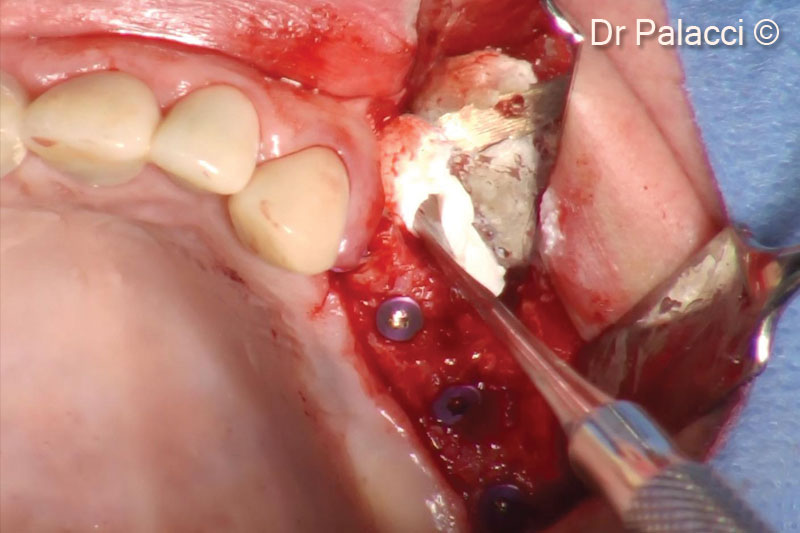 11. The concavity level in the apical portion of the first premolar, is filled with GTO® in order to recreate a natural ridge profile